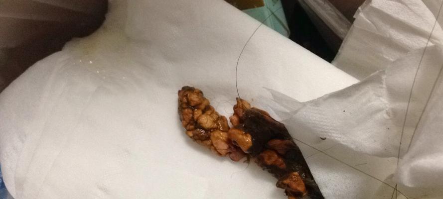 细小早期患者常见便便类型及早期识别指南(图1)