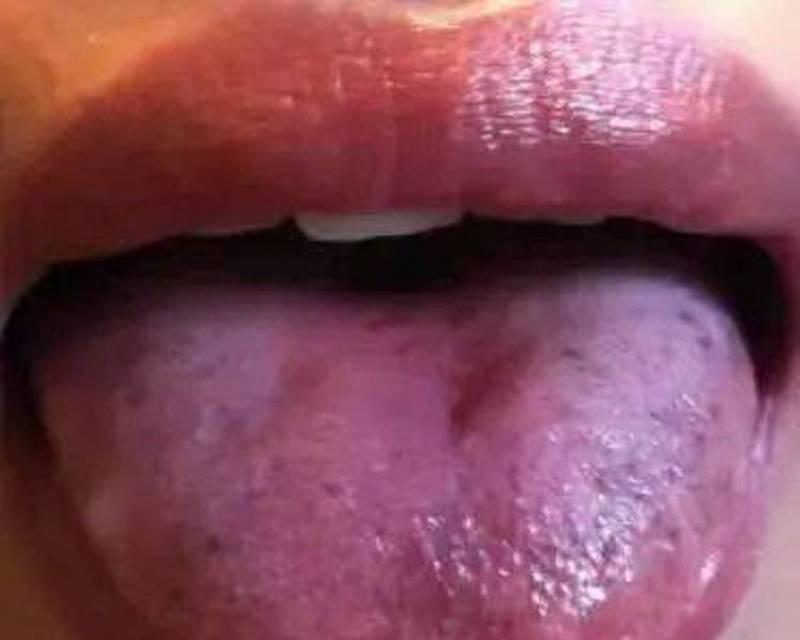 舌苔颜色的意义及影响(舌苔颜色的正常范围及可能的健康问题)(图2) 舌苔颜色的意义及影响(舌苔颜色的正常范围及可能的健康问题)(图2)