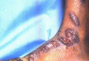 揭秘脓皮症的成因与治疗方法（探究脓皮症的症状、危害与预防方法）(图3)