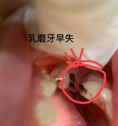 孩子大牙更替指南：正确时机与口腔保健建议(图3)