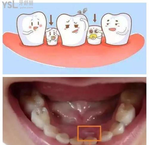 孩子大牙更替指南：正确时机与口腔保健建议 - 悠悠酷狗网