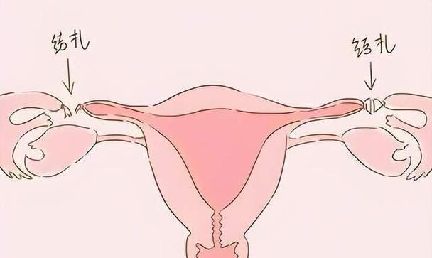 男子节育手术的恢复期及注意事项（男子节育手术恢复时间、禁忌症和注意事项）(图2)